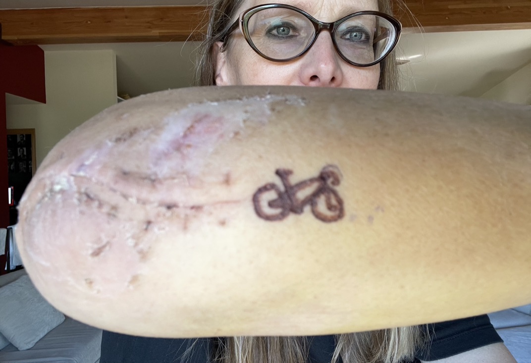 tracey scar healing with tattoo preview