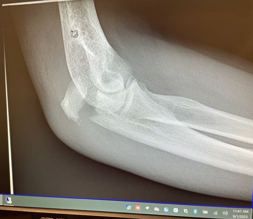 x-ray with broken elbow olecranon
