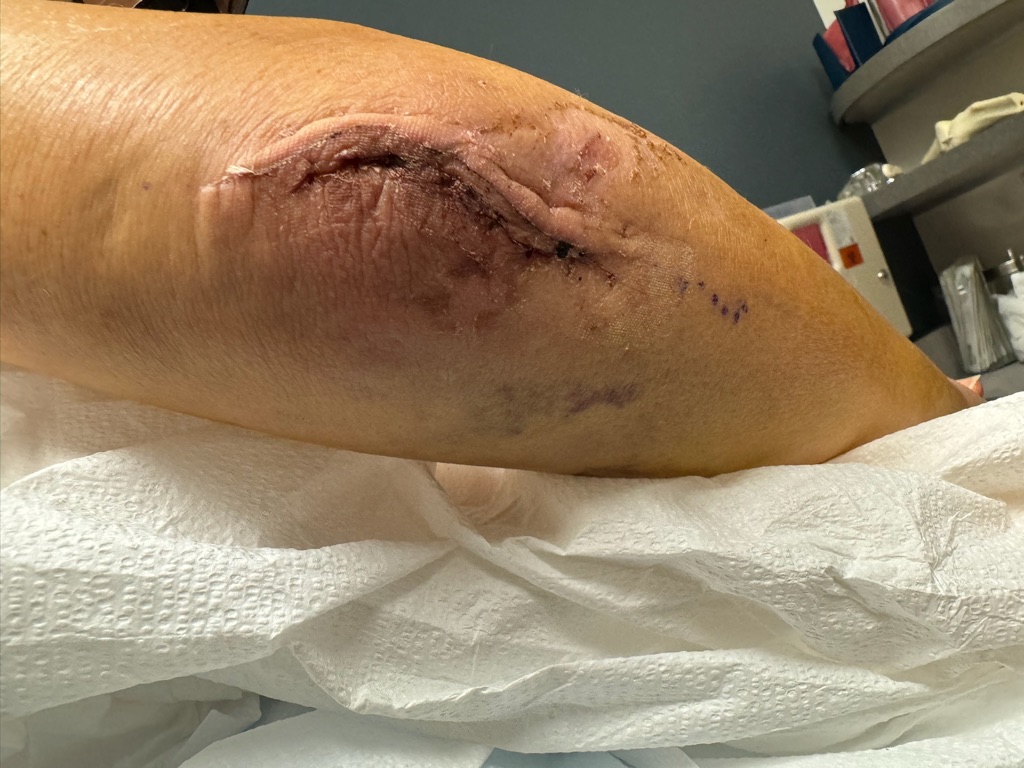 elbow with surgery scars